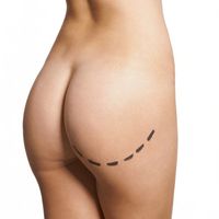 Fettaubsaugung (Liposuktion): Weg mit dem Fett!