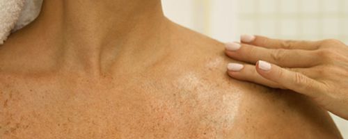 Hautkrebsvorsorge: Prüfen Sie regelmäßig Leberflecke & Co.!