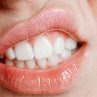 Spartrend in Großbritannien: Zähne selbst ziehen