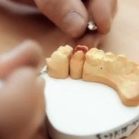 Mit Zahnimplantaten ein Leben lang gesunde Zähne!