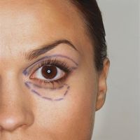 Augenlidkorrektur gegen Schlupflider: Strahlende Augen dank straffer Lider